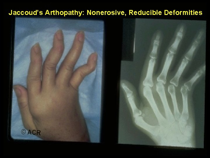 Jaccoud’s Arthopathy: Nonerosive, Reducible Deformities 