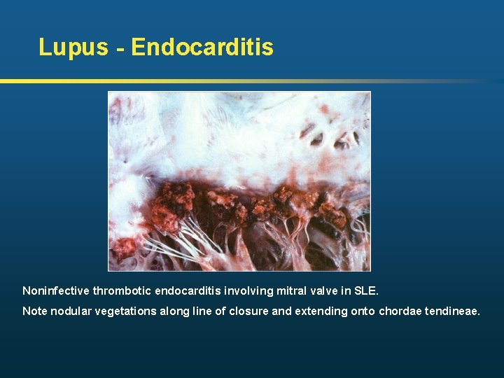 Lupus - Endocarditis Noninfective thrombotic endocarditis involving mitral valve in SLE. Note nodular vegetations