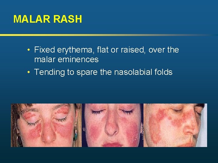 MALAR RASH • Fixed erythema, flat or raised, over the malar eminences • Tending