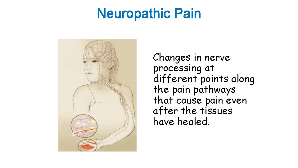 Neuropathic Pain Changes in nerve processing at different points along the pain pathways that