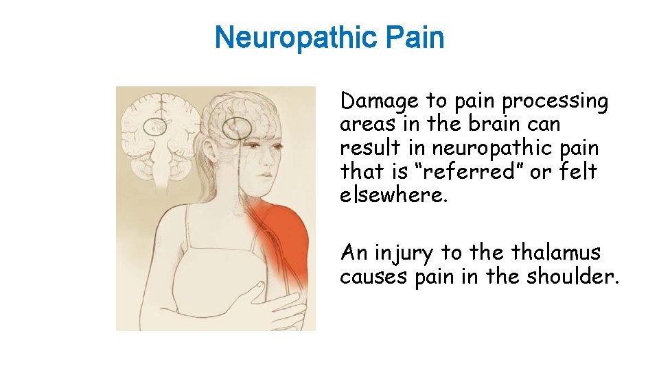 Neuropathic Pain Damage to pain processing areas in the brain can result in neuropathic