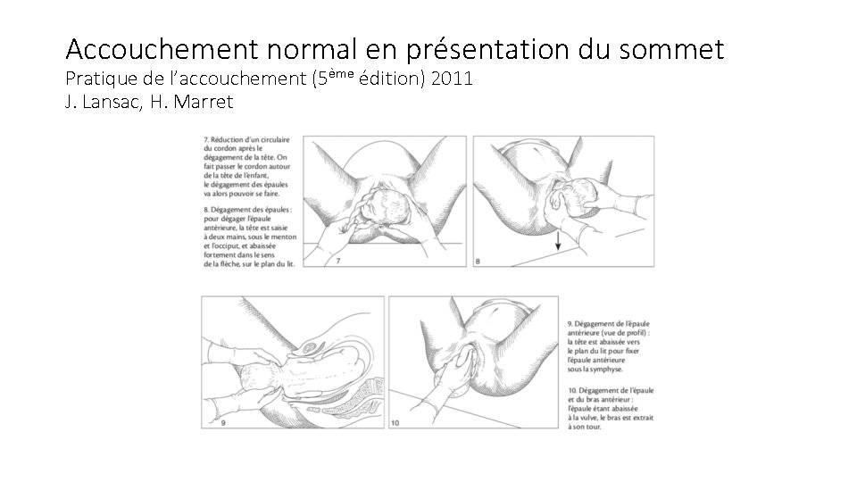 Accouchement normal en présentation du sommet Pratique de l’accouchement (5ème édition) 2011 J. Lansac,