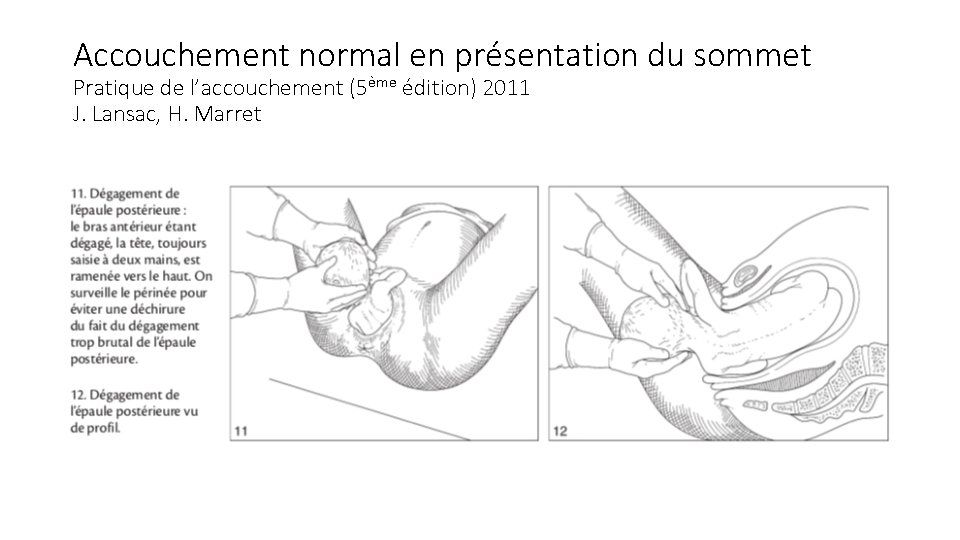 Accouchement normal en présentation du sommet Pratique de l’accouchement (5ème édition) 2011 J. Lansac,