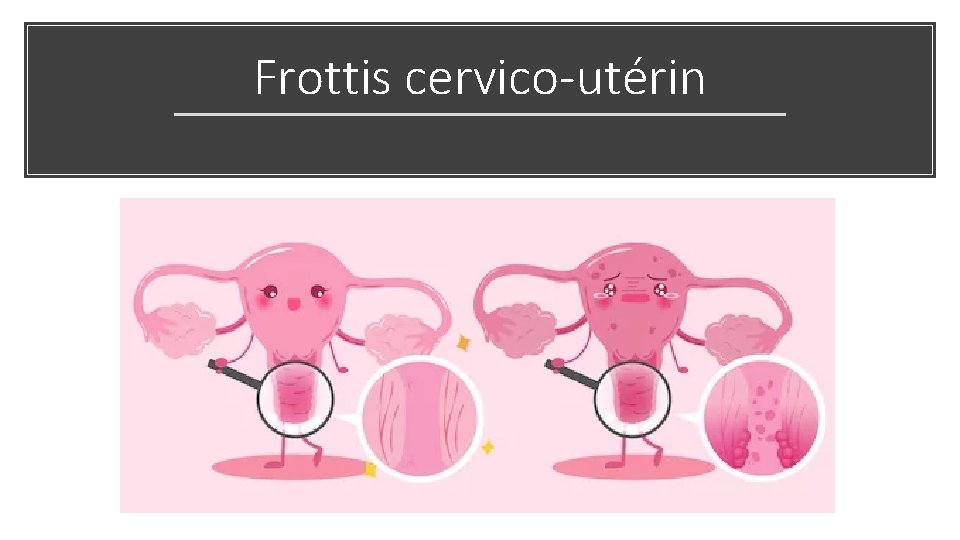 Frottis cervico-utérin 