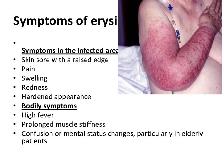Symptoms of erysipelas • • • Symptoms in the infected area Skin sore with