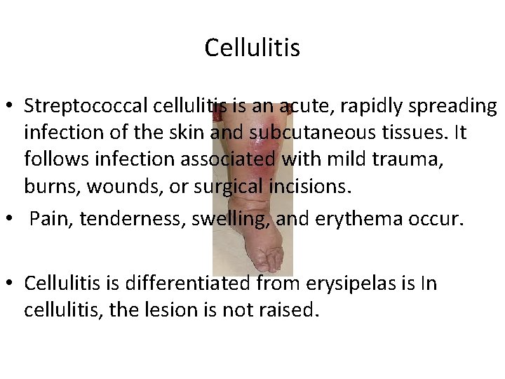 Cellulitis • Streptococcal cellulitis is an acute, rapidly spreading infection of the skin and