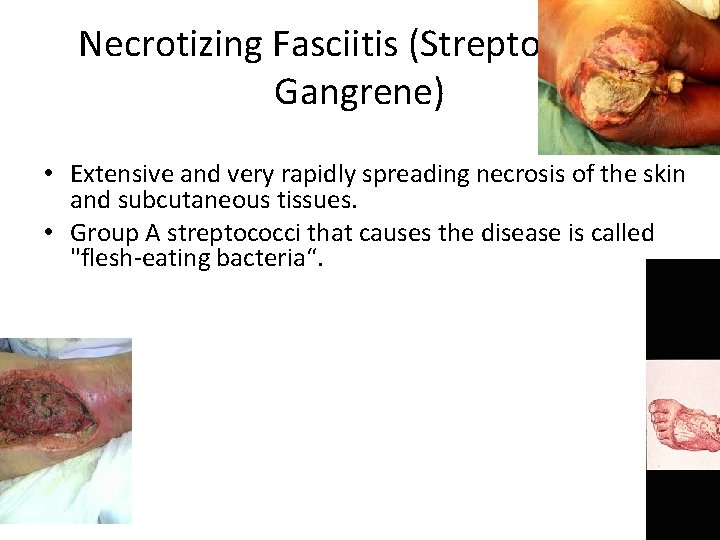 Necrotizing Fasciitis (Streptococcal Gangrene) • Extensive and very rapidly spreading necrosis of the skin