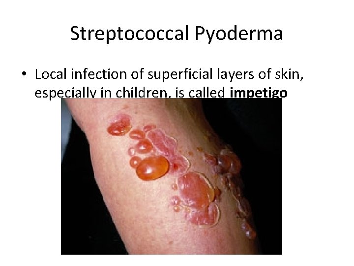Streptococcal Pyoderma • Local infection of superficial layers of skin, especially in children, is