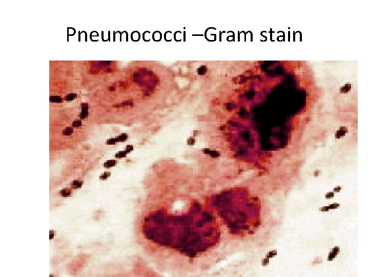 Pneumococci –Gram stain 