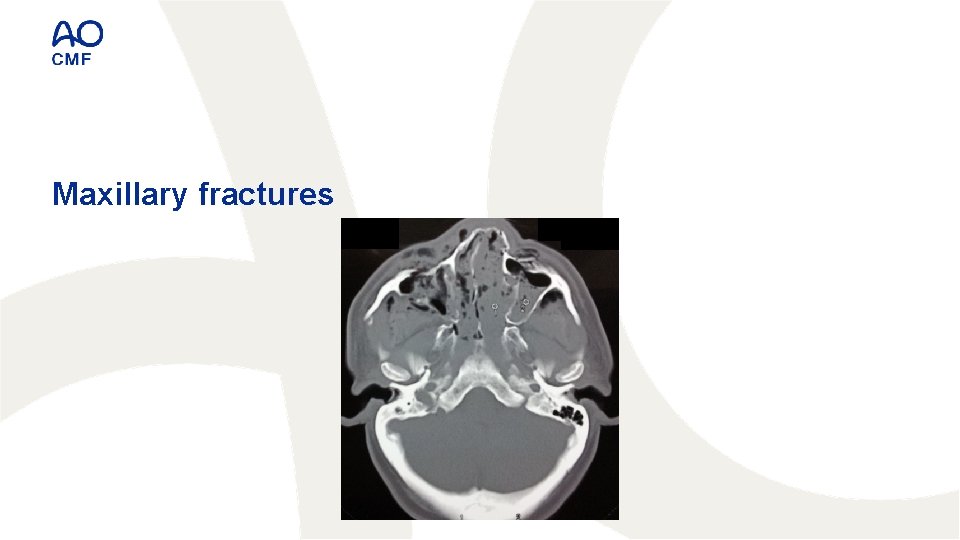 Maxillary fractures 