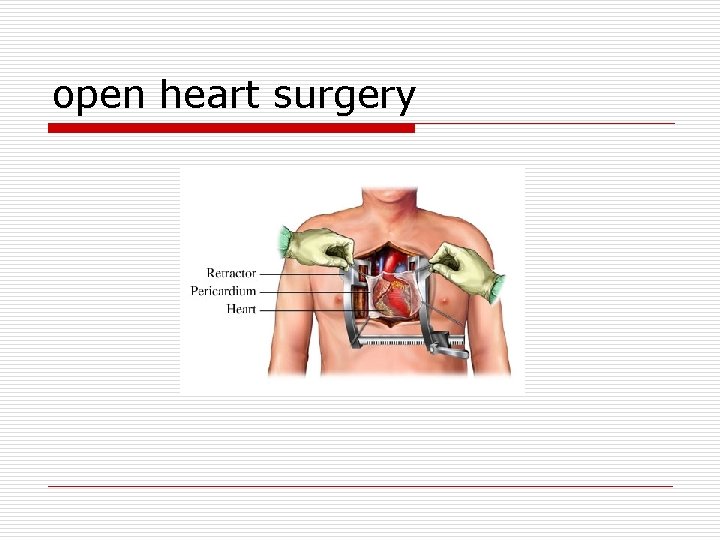 open heart surgery 