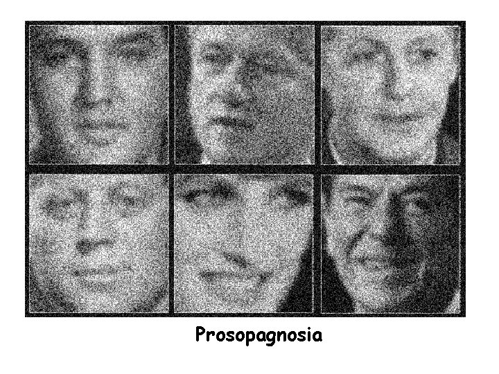. Prosopagnosia 