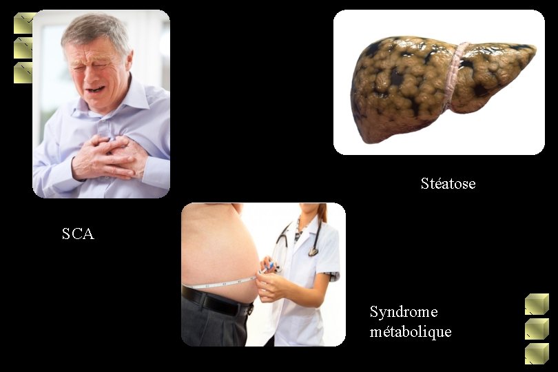 Stéatose SCA Syndrome métabolique 