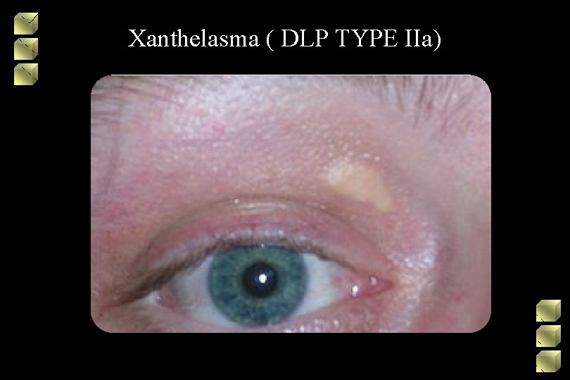 Xanthelasma ( DLP TYPE IIa) 