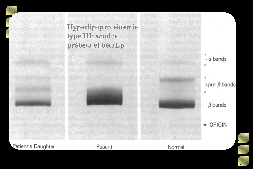 Hyperlipoprotéinémie type III: soudre prébéta et béta. Lp 