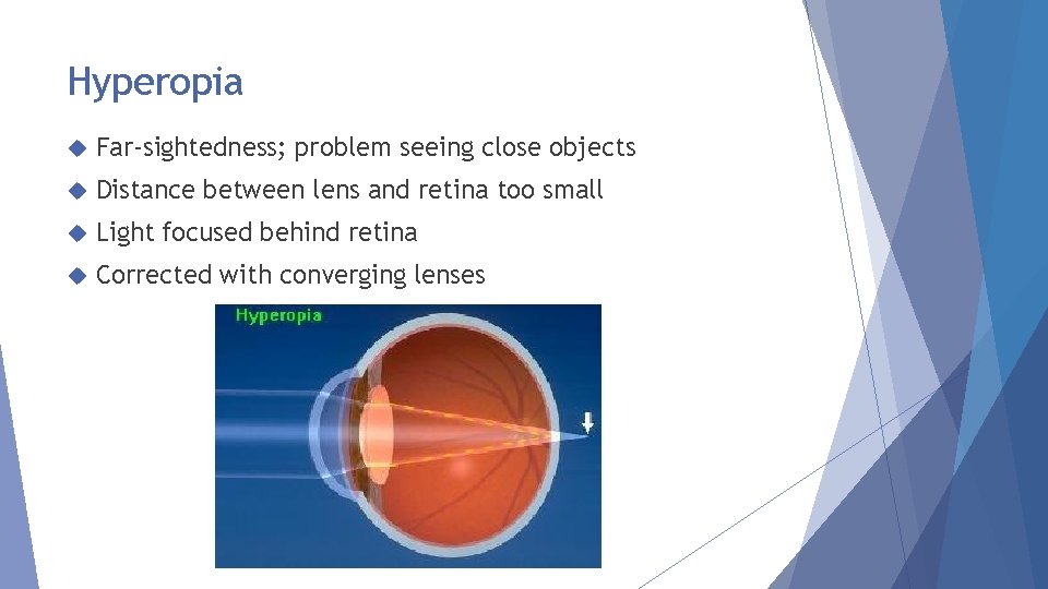 Hyperopia Far-sightedness; problem seeing close objects Distance between lens and retina too small Light