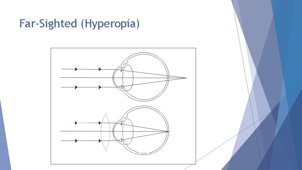 Far-Sighted (Hyperopia) 