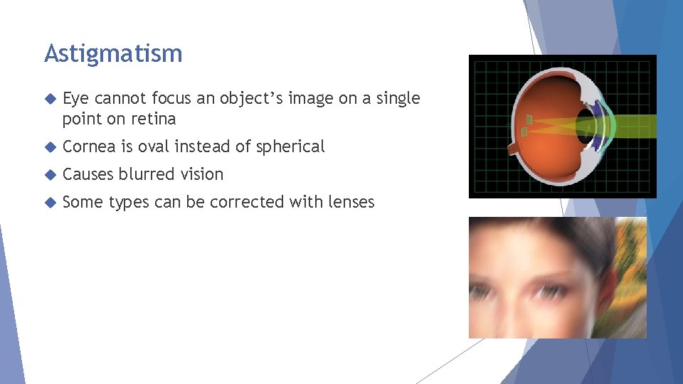 Astigmatism Eye cannot focus an object’s image on a single point on retina Cornea