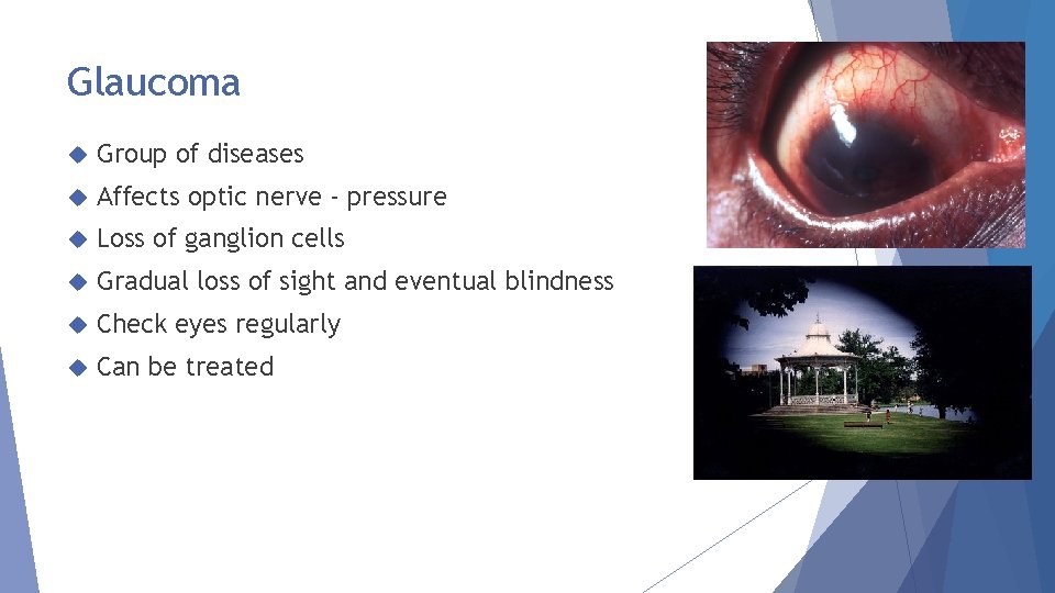 Glaucoma Group of diseases Affects optic nerve - pressure Loss of ganglion cells Gradual