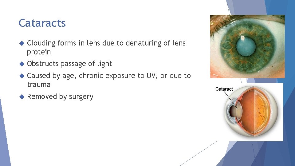 Cataracts Clouding forms in lens due to denaturing of lens protein Obstructs passage of