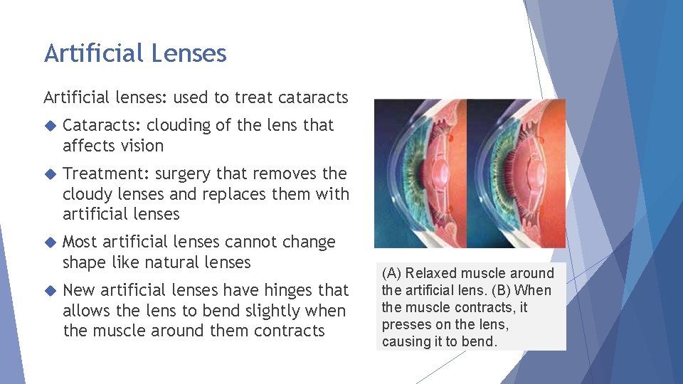 Artificial Lenses Artificial lenses: used to treat cataracts Cataracts: clouding of the lens that