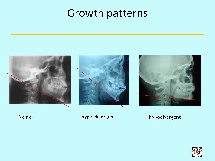 Growth patterns Nomal hyperdivergent hypodivergent 