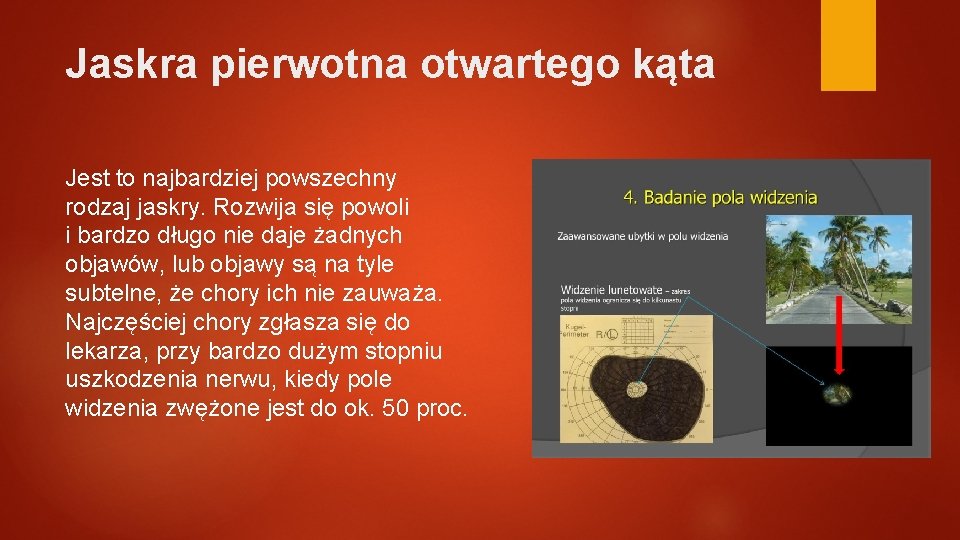 Jaskra pierwotna otwartego kąta Jest to najbardziej powszechny rodzaj jaskry. Rozwija się powoli i