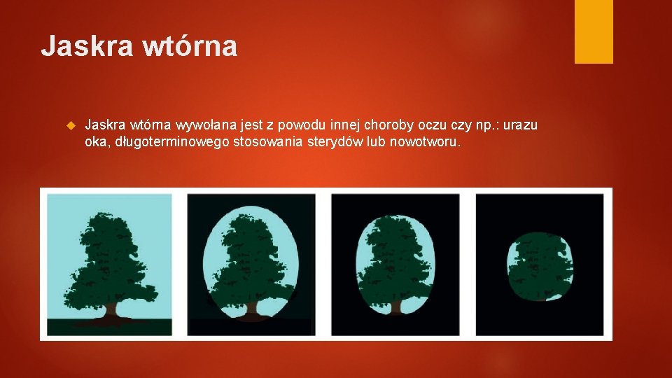 Jaskra wtórna wywołana jest z powodu innej choroby oczu czy np. : urazu oka,