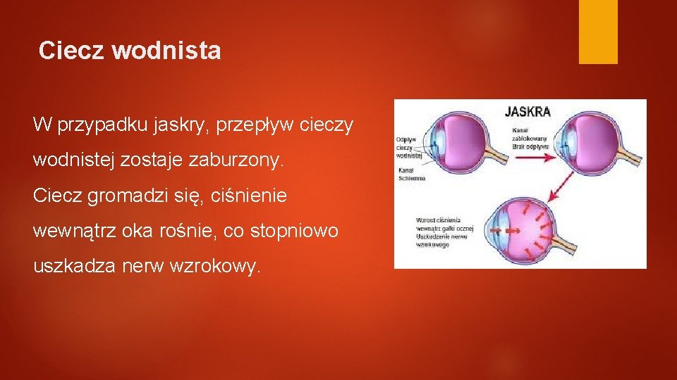 Ciecz wodnista W przypadku jaskry, przepływ cieczy wodnistej zostaje zaburzony. Ciecz gromadzi się, ciśnienie