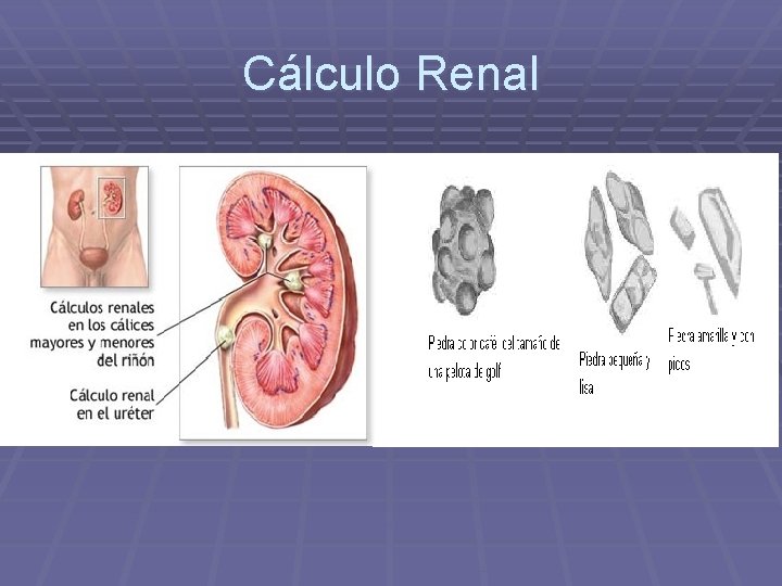 Cálculo Renal 