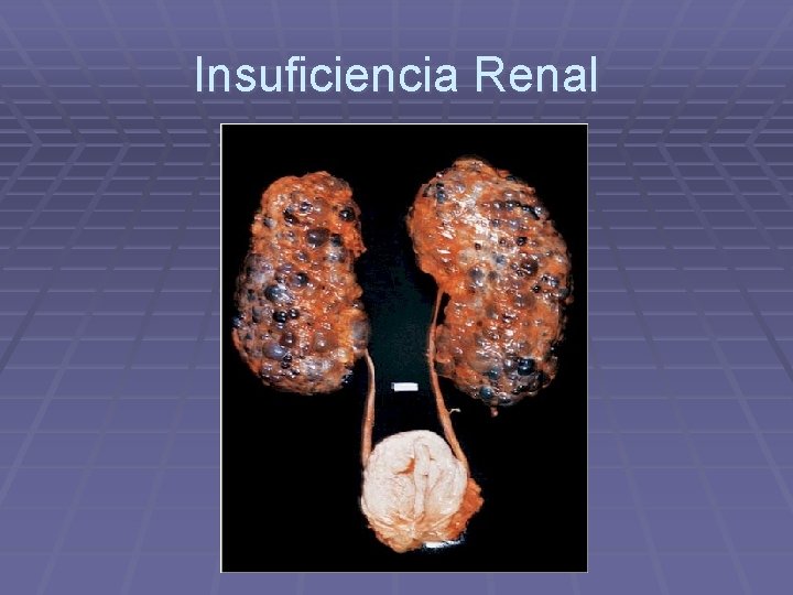 Insuficiencia Renal 