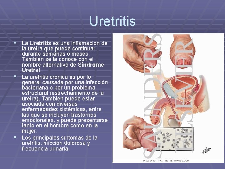 Uretritis § La Uretritis es una inflamación de la uretra que puede continuar durante