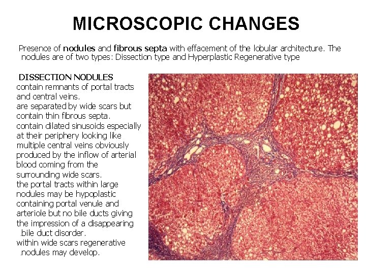 MICROSCOPIC CHANGES Presence of nodules and fibrous septa with effacement of the lobular architecture.