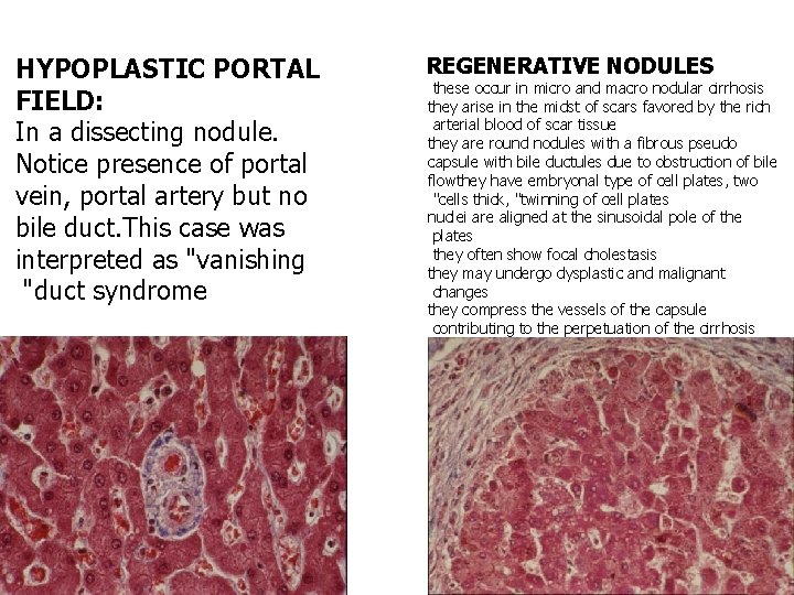 HYPOPLASTIC PORTAL FIELD: In a dissecting nodule. Notice presence of portal vein, portal artery