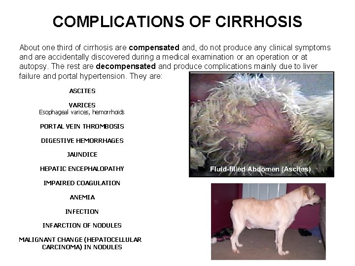 COMPLICATIONS OF CIRRHOSIS About one third of cirrhosis are compensated and, do not produce