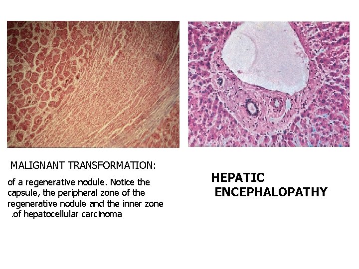 MALIGNANT TRANSFORMATION: of a regenerative nodule. Notice the capsule, the peripheral zone of the