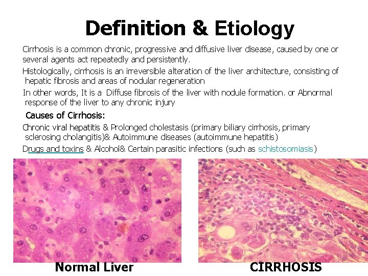 Definition & Etiology Cirrhosis is a common chronic, progressive and diffusive liver disease, caused
