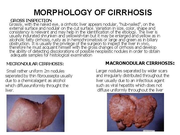 MORPHOLOGY OF CIRRHOSIS GROSS INSPECTION Grossly, with the naked eye, a cirrhotic liver appears
