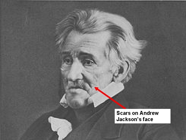 Scars on Andrew Jackson’s face 