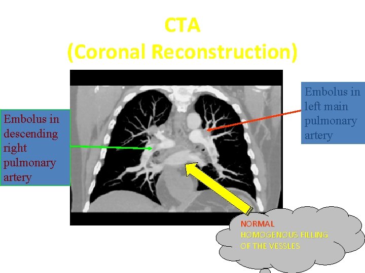 CTA (Coronal Reconstruction) Embolus in descending right pulmonary artery Embolus in left main pulmonary