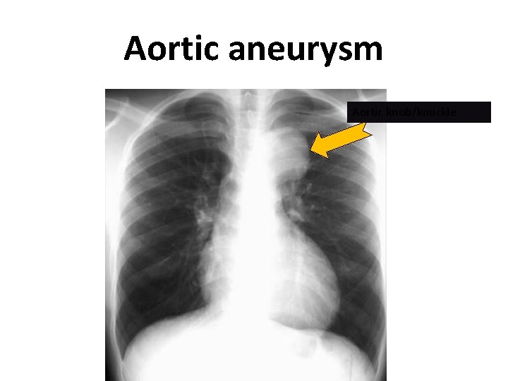 Aortic aneurysm Aortic knob/knuckle 