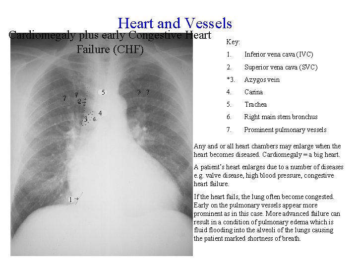 Heart and Vessels Cardiomegaly plus early Congestive Heart Failure (CHF) 5 7 2 7