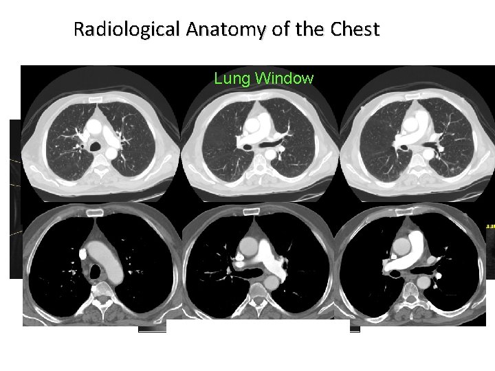Radiological Anatomy of the Chest Lung Window Sagittal Axial Mediastinal Window Coronal 