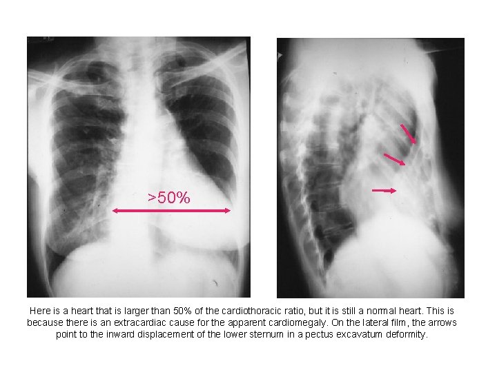 >50% Here is a heart that is larger than 50% of the cardiothoracic ratio,
