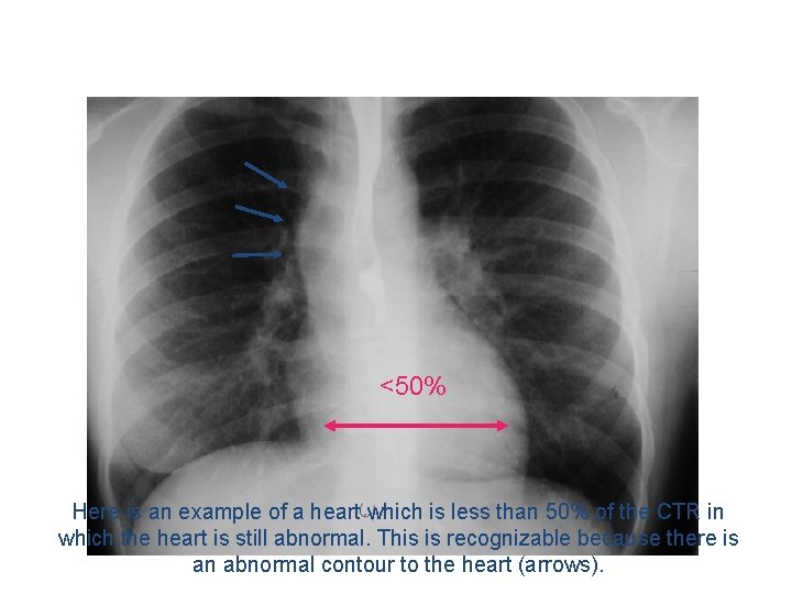 <50% Here is an example of a heart which is less than 50% of
