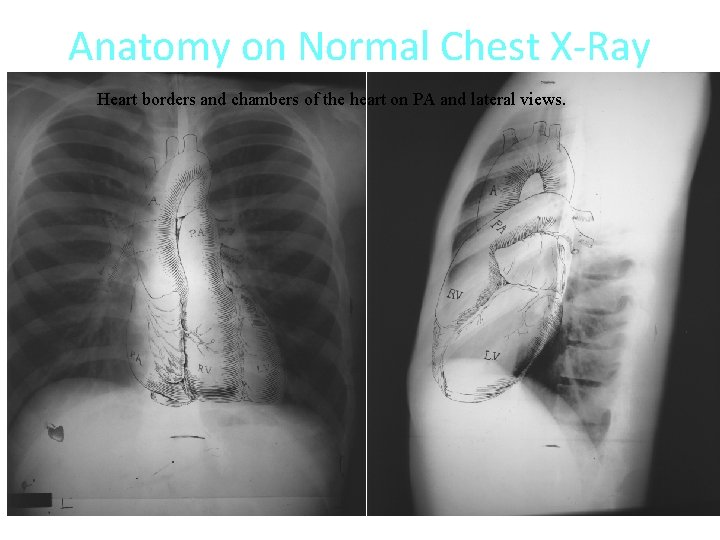 Anatomy on Normal Chest X-Ray Heart borders and chambers of the heart on PA