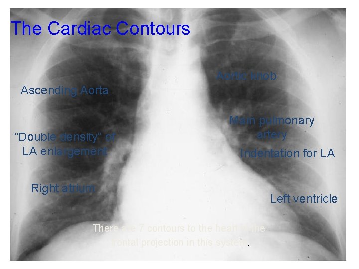 The Cardiac Contours Aortic knob Ascending Aorta “Double density” of LA enlargement Main pulmonary
