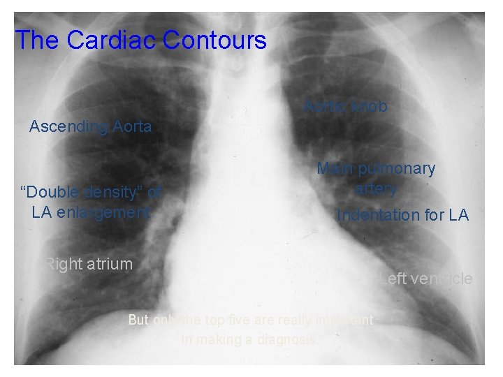 The Cardiac Contours Aortic knob Ascending Aorta “Double density” of LA enlargement Main pulmonary