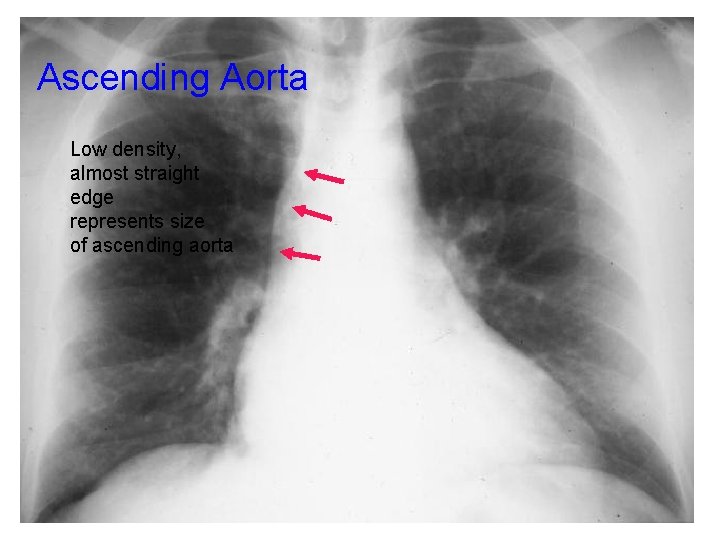 Ascending Aorta Low density, almost straight edge represents size of ascending aorta 