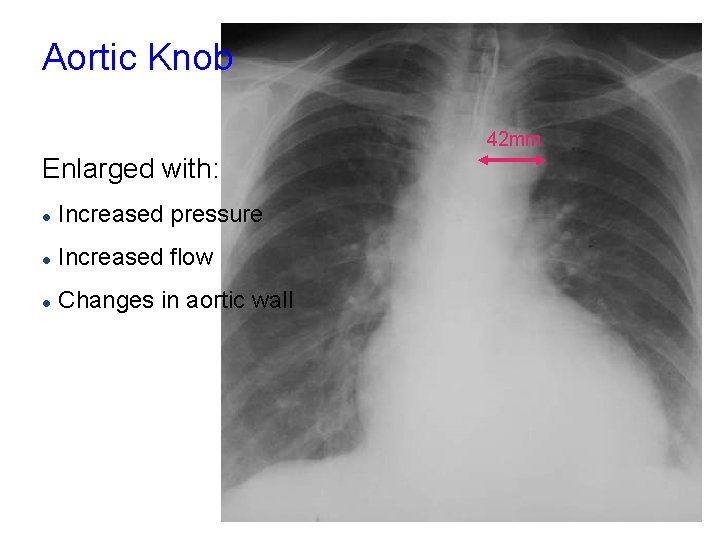 Aortic Knob 42 mm Enlarged with: l Increased pressure l Increased flow l Changes